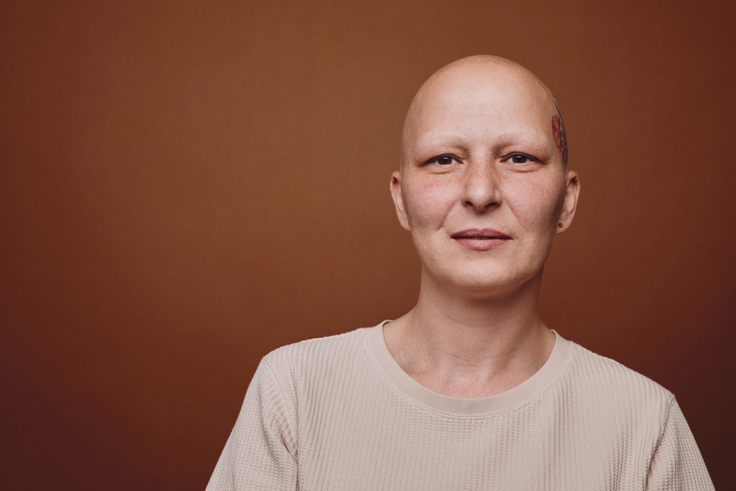What is alopecia?